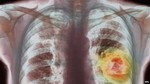 Bước tiến mới trong điều trị ung thư phổi
