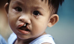 Còn khoảng 10.000 trẻ em bị hở môi, hở hàm ếch cần phẫu thuật