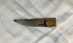 Lấy lưỡi dao dài gần 6cm đâm thấu ngực bệnh nhân