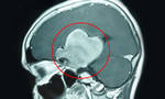 Lấy trọn khối u não khổng lồ cứu sống bệnh nhân