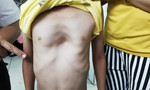 Bé trai mang 'hố sâu' ở ngực khiến tim nằm bên phải