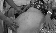 Người phụ nữ mang khối u buồng trứng khổng lồ, nặng 40kg
