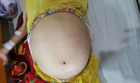 Người phụ nữ vác bụng to như trống vì khối u khủng 12kg trong tử cung