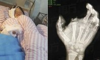 Bé trai 12 tuổi bị mù mắt, mất ngón tay do điện thoại phát nổ