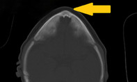 Tái tạo hộp sọ cho bệnh nhi có đầu hình tam giác