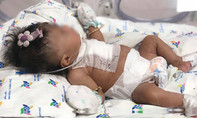 TP.HCM: 8 giờ cứu bé gái sơ sinh mắc 4 dị tật tim phức tạp
