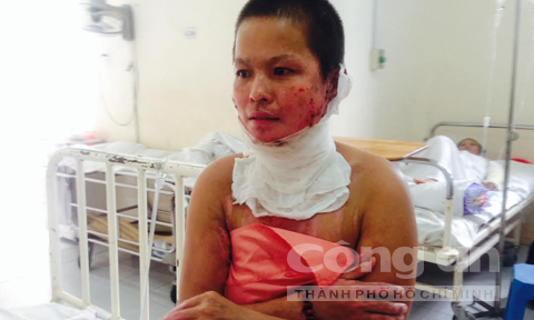 Chị Phạm Thị Tuyết Nga bị phỏng nặng