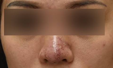 Nữ bệnh nhân bị sưng vùng mũi sau khi làm đẹp ở spa