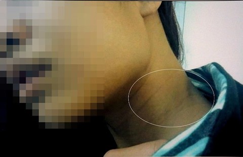 Vết bầm tím trên cổ bị hại.